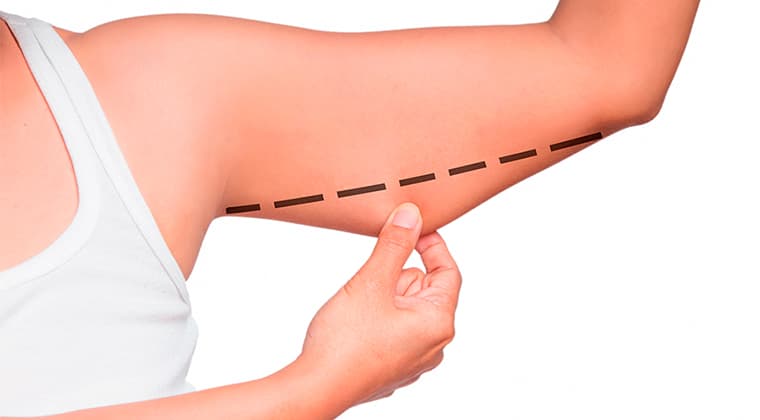 Mesoterapia en Brazos