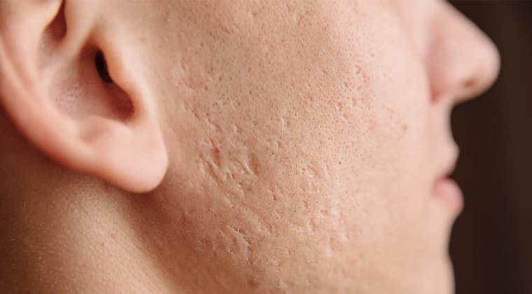 Acné y marcas de acné